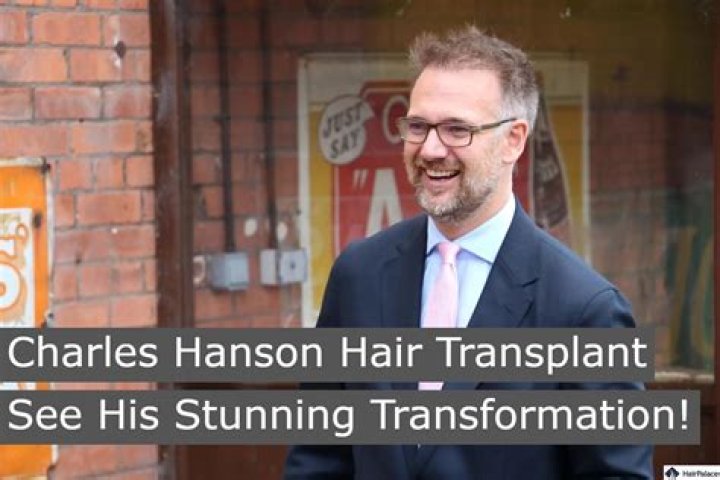 
Charles Hanson New Hair Look Post Cancer Diagnosis and Chemotherapy 