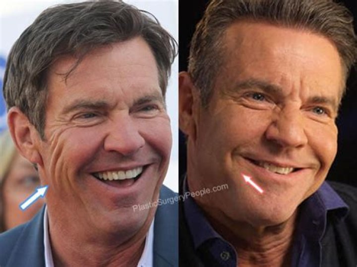 Dennis Quaid Plastic Surgery, Before After Pics – Age And Height Revealed