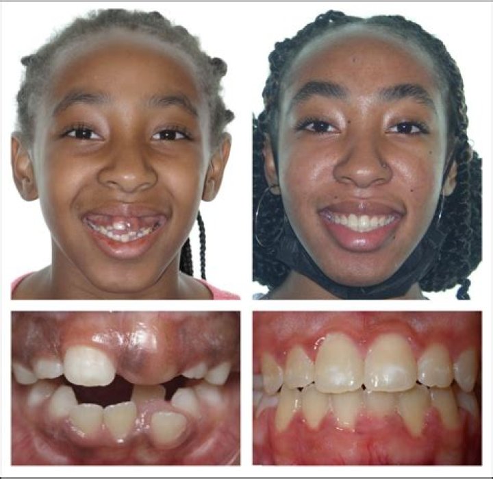 Explore Photos Of Coi Leray Teeth Before And After Braces -Changes Debunked!