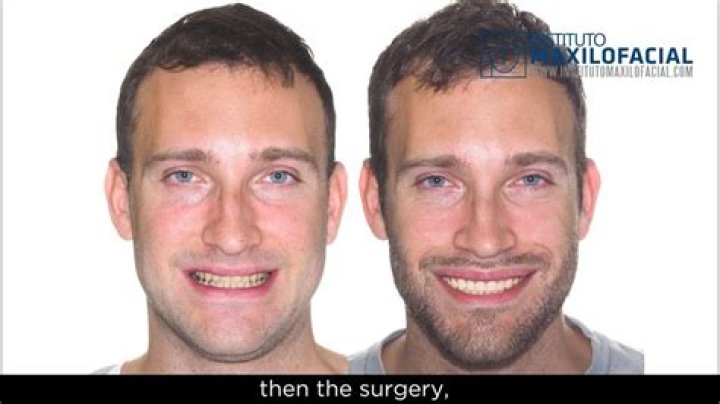 Here’s Why Anderson Cooper Might Have Had Plastic Surgery