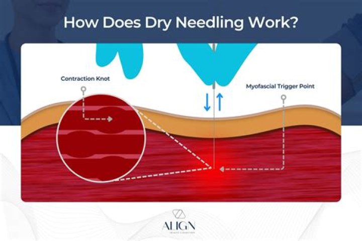 How does dry needling work
