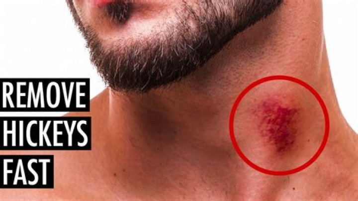 How to remove a hickey fast