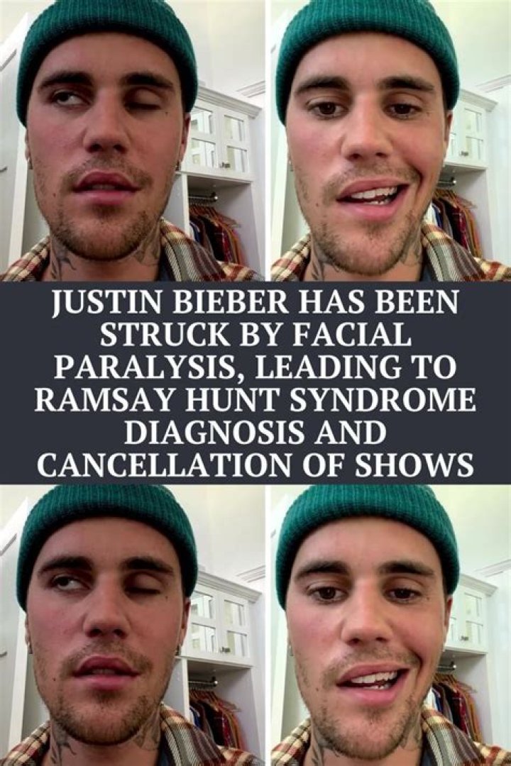 
Is Ramsay Hunt Syndrome Permanent? Justin Bieber Paralyzed Face Illness Explained 