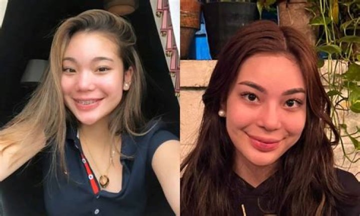 Kitty Duterte Nose Job: Before And After Surgery Photos