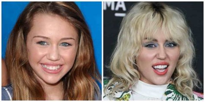 
Mackenzie Scott Teeth Before And After; Has American Novelist Has Done A Surgery? 