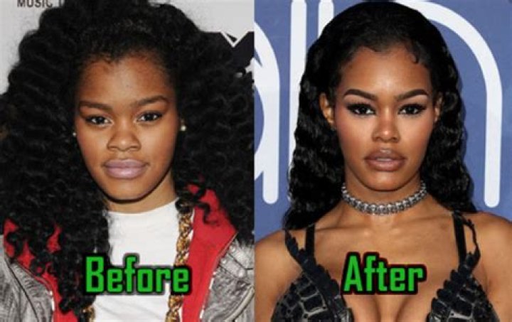 
Teyana Taylor Before Surgery – Did She Get Her Face Done? 