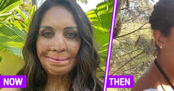 Turia Pitt’s story — Her recovery from 65% burns