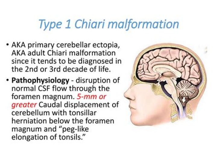 
What is Chiari malformation? Symptoms explored as Emily Balfour GoFundMe raises more than £28,000 