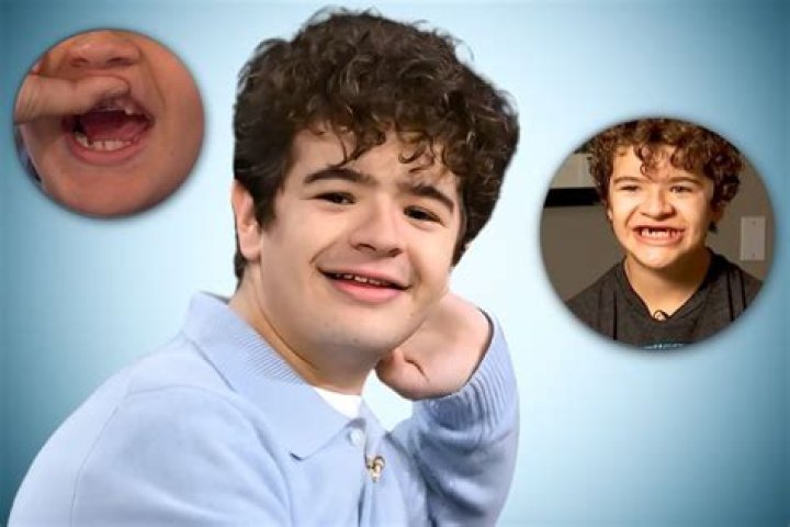 What Is Wrong With Gaten Matarazzo Teeth? More On Cleidocranial Dysplasia Surgery