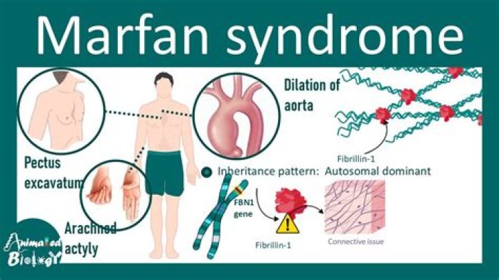 What syndrome does Troye Sivan have? How long can you live with Marfan syndrome?