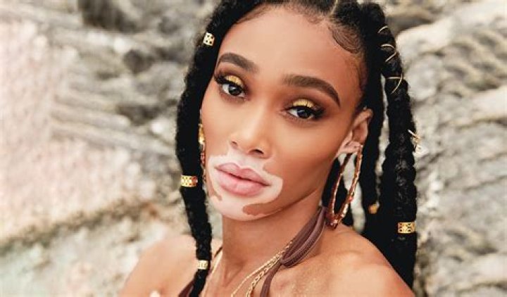 Winnie Harlow (Model) Wiki, Bio, Age, Height, Weight, Boyfriend, Measurements, Net Worth, Family, Facts